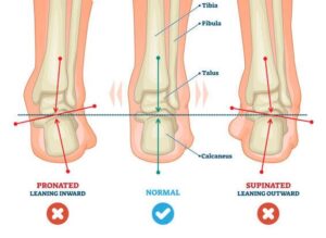 Foot supination and pronation vector illustration. Labeled medical scheme with incorrect leg joint movement. Educational diagram with pronated, normal and supinated compared examples with bone titles.