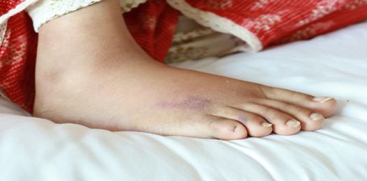 close-up-of-women-feet-with-swelling