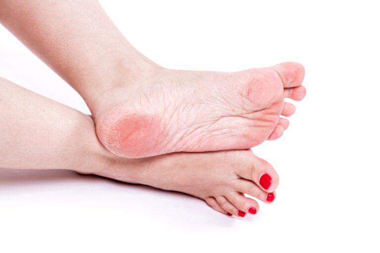 dry-dehydrated-skin-on-the-heels-of-female-feet-wi-